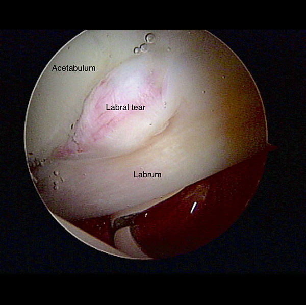 arthroscopy image showing a tear in the labrum of the right hip